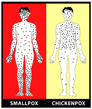 Localizarea primară a erupției cutanate cu variola(stânga) și varicelă (dreapta)