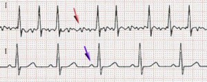 ECG înainte și după cardioversie electrică la fibrilație atrială