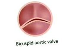 Valva aortică bicuspidă