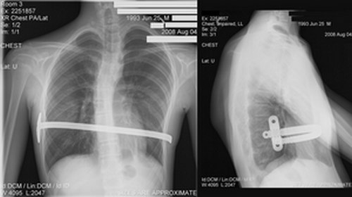 Radiografie a unui bărbat de 15 ani după ce a fost supus procedurii Nuss