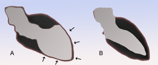 Imaginea schematică (A) Cardiomiopatie takotsubo și (B) normala