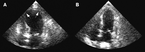 (A) Ecocardiogramă care arată dilatație acută a ventriculului stâng. (B) Recuperarea funcției ventriculare stângi prin ecocardiografie repetă 6 zile mai târziu.