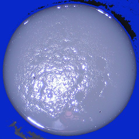 Diaree tipică de holeră care arată ca „apă de orez”