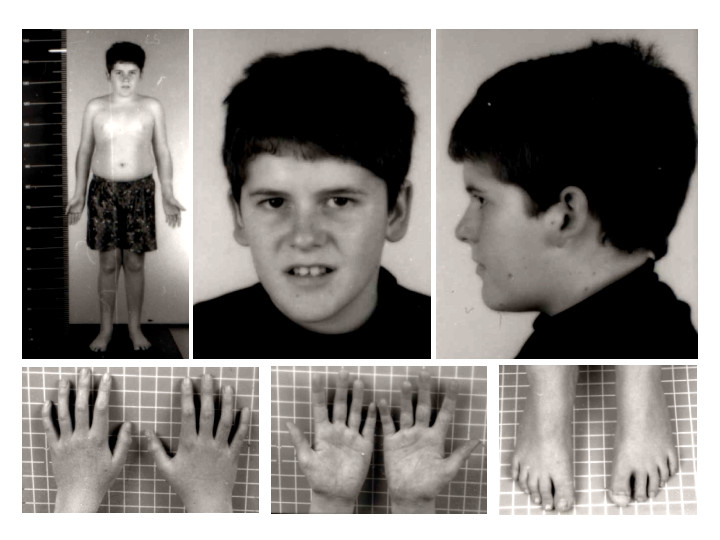Fenotipul sindromului Prader-Willi, la 15 ani