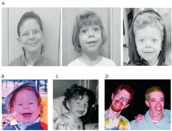 Mai multe persoane cu trăsăturile faciale caracteristice Sindromului Williams