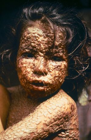 Fată din Bangladesh cu variolă (1973).