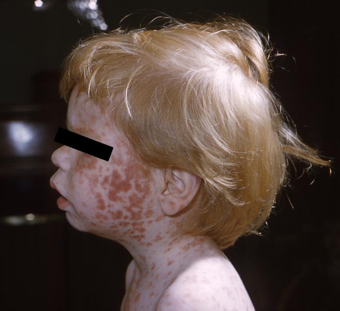 Băiat care prezintă erupția cutanată maculopapulară caracteristică a rubeolei