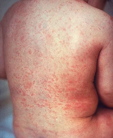 Erupție cutanată de rubeolă pe pielea spatelui copilului. Distribuția este similară cu cea a rujeolei, dar leziunile sunt mai puțin intens roșii.