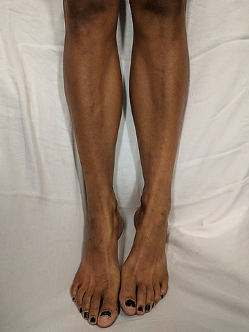 Picioarele unei femei caucaziene cu boala Addison