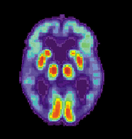 Scanarea PET a creierului Alzheimer arată declinul lobilor temporali
