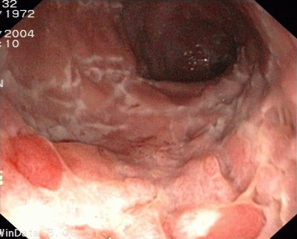 Ileita terminală în boala Crohn